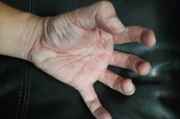 Dystonic hand